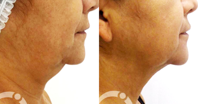 55-64 year old woman treated with Chin Surgery - 55-64 year old woman treated with Chin Surgery
