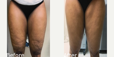 Woman treated with Cellulaze - Woman treated with Cellulaze
