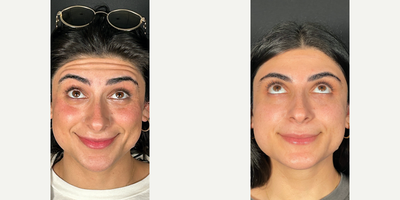 18-24 year old woman treated with Dermal Fillers, Xeomin - Under eye filler can help restore lost volume, camouflage bags, and brighten your under eye area for a refreshed look. Xeomin cosmetic was also performed to smooth her overactive muscles.