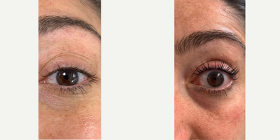 Woman treated with Yumi Lash Lift - Woman treated withYumiLash Lift
