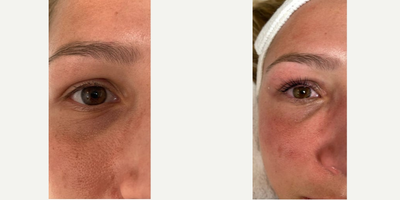 Woman treated with Yumi Lash Lift - Woman treated with Yumi Lash Lift