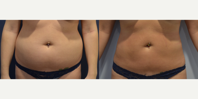 25-34 year old woman treated with Liposuction - This is an active young woman who exhausted her ability to achieve her goals through diet & exercise. She finally tried liposuction of her abdomen & flanks.