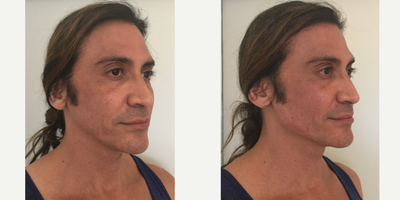 35-44 year old man treated with ArteFill - This patient was injected with Artefill / Bellafill for a Non Surgical Jaw Enhancement.