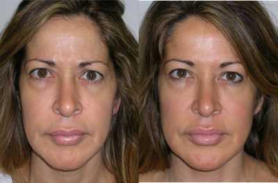 Botox - 50 year old female before and one week after 50 units of Botox was injected into the area between her eyes, brow and forehead