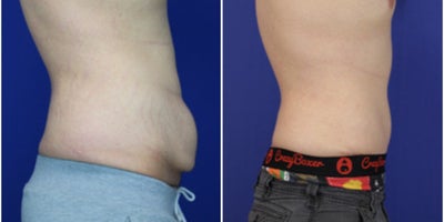 18-24 year old man treated with Male Tummy Tuck - Mae abdominoplasty - lost 100 lbs. Age 24yo 6 months post