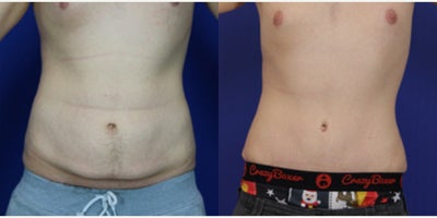 18-24 year old man treated with Male Tummy Tuck - Mae abdominoplasty - lost 100 lbs. Age 24yo 6 months post