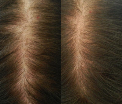45-54 year old woman treated with Thinning Hair - Carboxy therapy and prp for hair loss, 6 carboxy sessions one week apart 3 prp sessions 1 month apart.