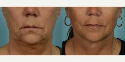 55-64 year old woman treated with Facelift, Lower Facelift, Neck Lift, Laser Resurfacing, Dermabrasion - At age 62, this patient sought to make her outward appearance better reflect her active and vibrant lifestyle. After having her primary facelift over a decade ago, she decided to pursue another procedure, opting for a secondary deep plane facelift, along with perioral fat grafting and ablative laser with spot dermabrasion around her mouth. She selected 'Facelift/Minilift by Dr. Mustoe in Chicago' due to his expertise and innovative approach to these techniques. The patient wanted to tighten her neck and soften deep wrinkles and lines, aiming for a more youthful look which is compatible with her energetic outdoor activities and regular boating adventures.The procedures were meticulously carried out under local anesthesia and oral sedation in Dr. Mustoe's office, negating the need for drains, a testament to his innovative technique. This patient's zest for life was reflected in her quick recovery, as she was back socializing with her friends effortlessly just four days post-procedure. She reported finding the recovery process smooth and easy, and is delighted with her refreshed and rejuvenated appearance.