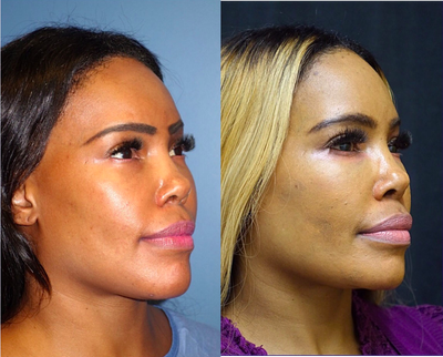 Chin Surgery - Chin Surgery