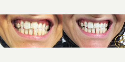 Patient treated with Teeth Whitening - Smyle teeth whitening treatment.