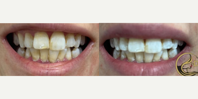 Patient treated with Teeth Whitening - Check out these amazing before and after pictures from one 30-minute treatment. SMYLE XO Teeth Whitening System provides instant stunning results!!