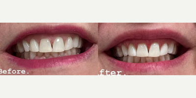 Woman treated with Teeth Whitening - Check out these fabulous before/after pictures! This is only 1 treatment! Our SMYLE XO teeth Whitening System Gives INSTANT and Beautiful results! Call Our Office and ask for Justine! She will answer all your questions and schedule you with your own 30-minute teeth whitening session!
