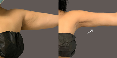 45-54 year old woman treated with AirSculpt - Patient has received AirSculpt on their underarms in our New York location.