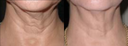 Skintyte - As we age our skin loses it's elasticity. The SkinTyte treatment is based on the principe of selective thermolysis and utilizes pulsed light technology to deeply heat your skin while cooling and protecting the entire treated surface.