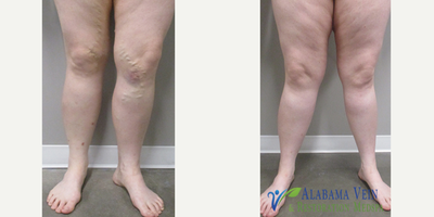 35-44 year old woman treated with EVLT - Varicose Vein treatment before and after at Alabama Vein & Restoration Medspa