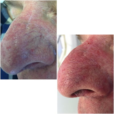 45-54 year old man with facial spider veins treated with VeinGogh - Our patient presented with spider veins not he cheek and nose. treated with VeinGogh. Immediate results shown.