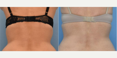 Woman treated with CoolSculpting - Woman treated with CoolSculpting.