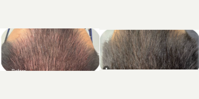 35-44 year old man treated with Mesotherapy - Early intervention is essential for male type hair loss (androgenetic alopecia). We benefit from mesotherapy and PRP which reduce hair loss and thicken the hair, thus giving it a more strong appearance. It should not be forgotten that the effects of the treatments will begin to be seen after 3 months. If you continue maintenance therapy regularly, success rate will surely increase