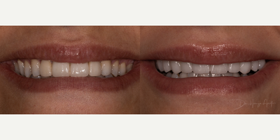 25-34 year old woman treated with Lumineers - Uneven smile, teeth alignment, discoloration and asymmetric teeth all enhanced with minimal prepped veneers. With just two appointments, this patient had a new functional and aesthetic smile. 10 feldspathic porcelain veneers were used in this case.