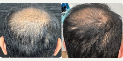 35-44 year old man treated with PRP for Hair Loss - PRP hair restoration and Fotona laser  Hairlase/ HaiRestart are two procedures at our clinic to fight hair loss. PRP injection is a natural way to inject your own growth factors to your scalp and stimulate new hair growth while decreasing shedding. Fotona laser helps to grow new hair and decrease hair loss as well. We have a very high success rate for both procedures at our clinics. This after picture is after only 2 sessions.