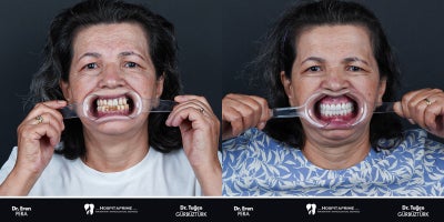 55-64 year old woman treated with Dental Implants, Dental Crown - Looking for cost-effective and advanced dental implant solutions? Dental implants in Turkey are a popular choice for restoring missing teeth. Using the all-on-4 or all-on-6 techniques, full arches can be replaced with 4 or 6 implants, eliminating the need for bone grafts in many cases.These methods offer faster recovery, excellent stability, and natural aesthetics. Plus, with competitive dental implant prices, Turkey has become a top destination for high-quality dental care.Start your journey to a confident smile today with innovative and affordable treatments.
