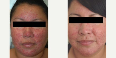 Got Redness?  Not with Vbeam treatments - If you're struggling with facial redness or acne rosacea, we've got a solution for you.  If you've tried over the counter and prescription options without success, give us a call today about Vbeam pulsed dye laser treatments for Rosacea.