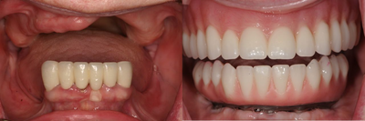 Same Day Teeth- Immediate implants and teeth - 
	Patient had few remaining lower teeth and an ill-fitting partial denture. She had great difficulty eating and continued to lose bone from the denture. Following a 3-Dimensional computer assisted planning, patient's lower teeth were extracted, five dental implants placed immediately, and then restored with a fixed prosthesis- All on the same day. Following three months of healing, a final lower fixed prosthesis was delivered. This is a hybrid prosthesis which is easy to clean, comfortable and strong to eat with, and looks great revealing her new smile. This treatment was provided through a team approach with Dr. Kazemi as the surgeon and a prosthodontist fabricating the teeth.
