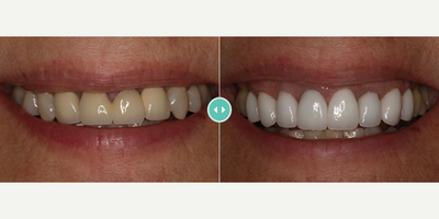 Woman treated with Porcelain Veneers - Woman treated with Porcelain Veneers