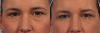 Juvederm Ultra for under-eye bags - Juvederm Ultra Plus treatment to the tear trough to reduce under eye bags and shadows.