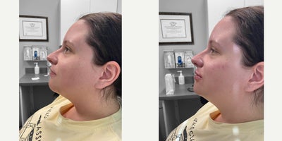 25-34 year old woman treated with Chin Filler - Facial contouring with Dr. Wise: Chin/jawline, cheeks, lips