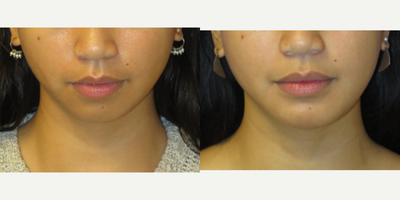 24 year old woman treated with Chin Implant - This is a 24 year old female who did not like her recessive chin. She had a Medium Extended Anatomical Chin Implant by Implantech. Note the natural enhancement of her chin and anterior jawline giving more balance in her face.