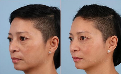 Woman treated with Restylane Lyft - Fillers to the cheeks and tear troughs can help soften the lid-cheek junction and replace volume loss in the mid face.