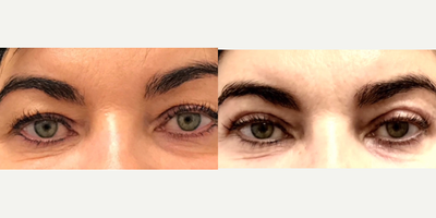 45-54 year old woman treated with Eyelid Surgery - 46 y.o female who was concerned with upper eye hooding underwent upper blepharoplasty under local anesthesia.  At 2 months post-op, her upper eye hooding is gone resulting in rejuvenated appearance.