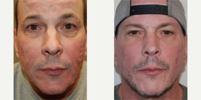 35-44 year old man treated with Scar Removal, Silikon 1000 - We are beyond grateful that our handsome patient has allowed us to post his before and after photos following two treatments with microdroplet Silikon-1000 for permanent Improvement of broad-based and depressed acne scars. Before seeing us, he has had laser treatments and microdroplet Silikon-1000 from three other physicians located in New York City. Before we continued on in his care, the last surgeon to treat him with Silikon-1000 was my mentor, the late, great Dr Jay Barnett.In our experience, fractionated lasers and other minimally invasive procedures are not always adequate or helpful in addressing people's acne scarring. During our 25 years of experience, patients who are well suited for microdroplet Silikon-1000 treatments for acne scarring end up becoming some of the happiest people that we have cared for.