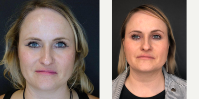 35-44 year old woman treated with Jessner Peel - After 3 Chemical Peels and 1 IPL! Beautiful!