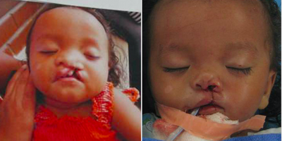 Cleft Lip And Palate Repair - This four month old girl had a wide complete cleft lip and alveolar cleft (left), and was repaired by Dr. Ransom (right).