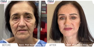 55-64 year old woman treated with Deep Plane Facelift, Forehead Reduction, Eyelid Surgery, Lip Lift - 55-64 year old woman treated with Deep Plane Facelift, Forehead Reduction, Eyelid Surgery, Lip Lift