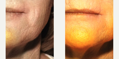Woman treated with Profound RF - Woman treated with Profound RF