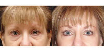 55-64 year old woman treated with Eyelid Surgery - Subperiosteal Brow Lift, Lower Blepharoplasty