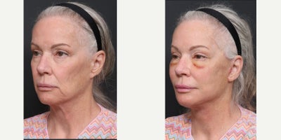68-70 year old woman treated with Facelift Revision, Neck Lift Revision, Eyelid Surgery Revision, Facial Fat Transfer - Facelift RevisionNeck Lift RevisionLower Blepharoplasty RevisionFacial Fat Transfer