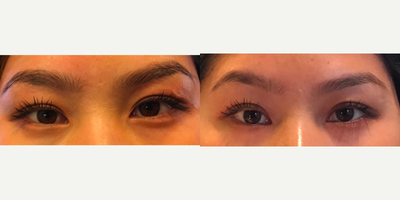 18-24 year old woman Brow Lift with Thermi Smooth - 24 year old desire right brow lift.  Single painless 15 min procedure with Thermi Smooth.