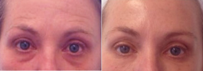 45-54 year old woman treated with Exilis - 4 treatment sessions of Protege Exilis for under eye area skin tightening also with undereye restylane filler