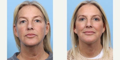 45-54 year old woman treated with Eyelid Surgery, Deep Plane Facelift - This patient wanted to fix the appearance of sagging upper eyelids, double chin, and remove loose skin, specifically from her neck and jawline. Dr. Wise performed an upper blepharoplasty to remove excess skin and lift the eyes, as well as a deep plane facelift to tighten the skin. The combination of these procedures resulted in a more youthful, rejuvenated appearance.