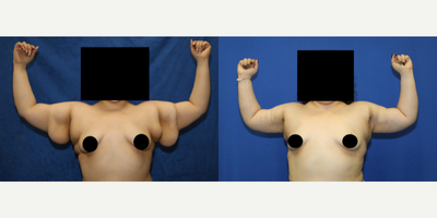 25-34 year old woman treated with Arm Lift - Meet patient, a 31-year-old white female who stands at 5'0 and weighs 190 pounds. She was unhappy with the excess skin and fat in her arms, which made her feel self-conscious and uncomfortable.In search of a solution, she decided to undergo a brachioplasty, also known as an arm lift, with the exceptional Dr. J. Timothy Katzen in Beverly Hills, CA. The procedure was successful in removing the excess skin and fat, resulting in significantly smaller and better-shaped arms.We are thrilled to hear that the patient is very pleased with her results. It's inspiring to see how cosmetic procedures can help individuals not just achieve their desired appearance but also improve their confidence and well-being.We wish her continued health and happiness and applaud her for taking the necessary steps towards achieving her goals.