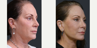 65-74 year old woman treated with Facelift, Facial Fat Transfer, Dermabrasion, Eyelid Surgery - This patient underwent a 3-D (Y-SMAS) facelift, facial fat transfer, lower blepharoplasty, CO2 lasabrasion and perioral medical diamond dermabrasionA 3-D (Y-SMAS) facelift is a more complete dissection employing 3 vectors. I consider it like a deep plane facelift but more sculptural and in my experience, it lasts longer and it is more effective for the nasolabial folds.