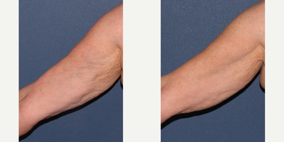 45-54 year old woman treated with ThermiTight - Lax skin on the arms is tightened using ThermiTight's radiofrequency energy.