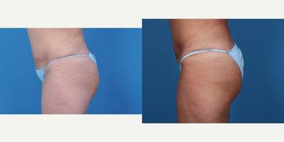 35-44 year old woman treated with Brazilian Butt Lift - brazilian Butt Lift490ml fat injected into left buttock505ml fat injected into right buttock