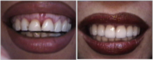 35 year old female with gummy smile - Patient did not like her gummy smile. The treatment consisted of lip lowering procedure, gum re-contouring, and placing porcelain veneers to change the shape and color of the teeth.&nbsp;