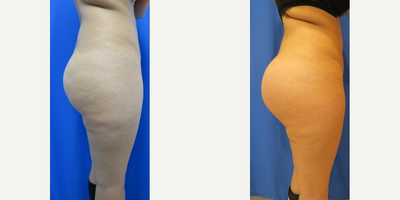 Woman treated with Butt Implants - Woman treated with Butt Implants