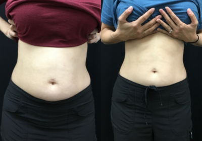 Muscle definition and fat loss with Emsculpt - This patient was about 6 months postpartum, and had a little abdominal separation from her childbirth (diastasis recti). As you can see, Emsculpt benefits everyone and in this case she was able to lose about 2 inches off her waistline.